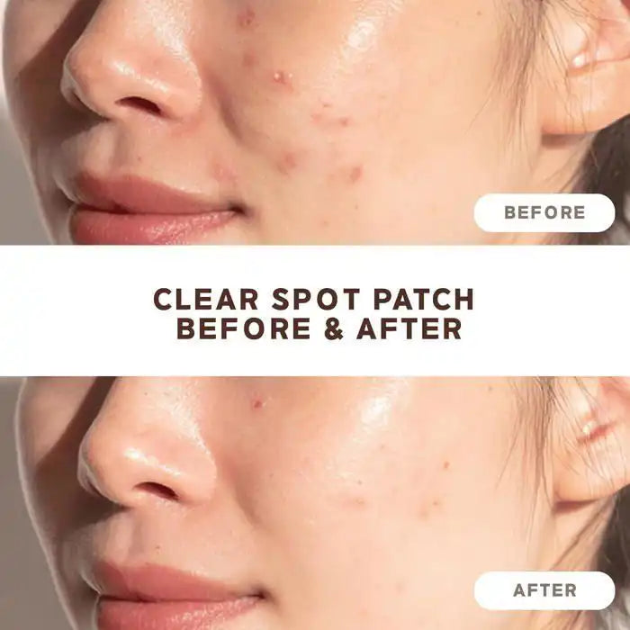 NOLAHOUR Clear Spot Patch – 26 patchs