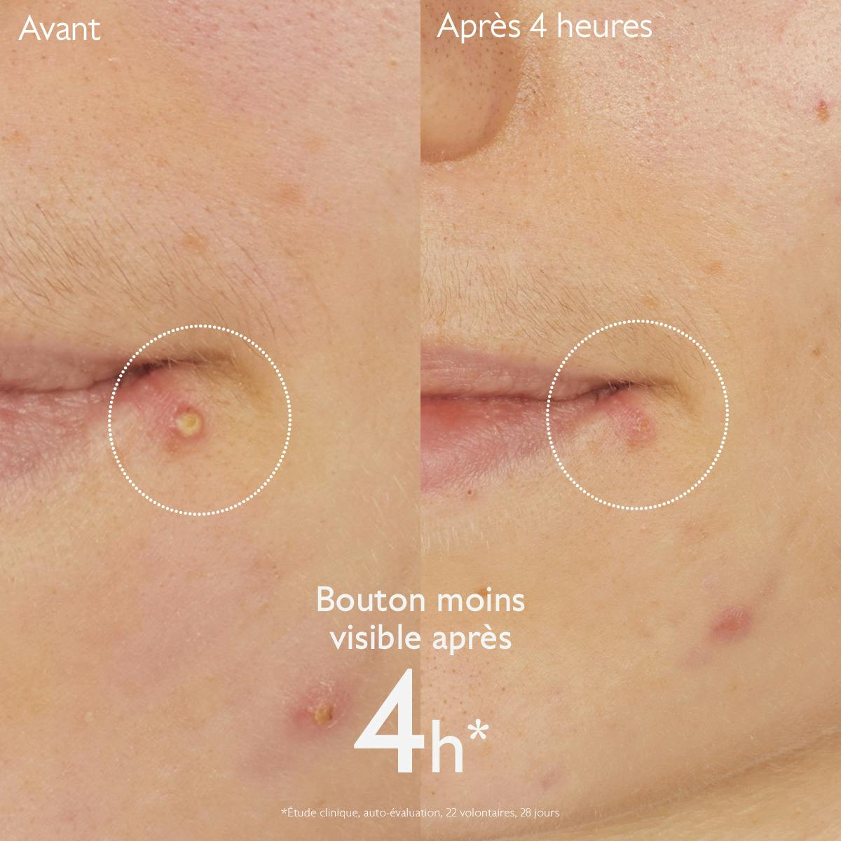 Caudalie Vinopure Stop Boutons Salicylique Caudalie - 15ml